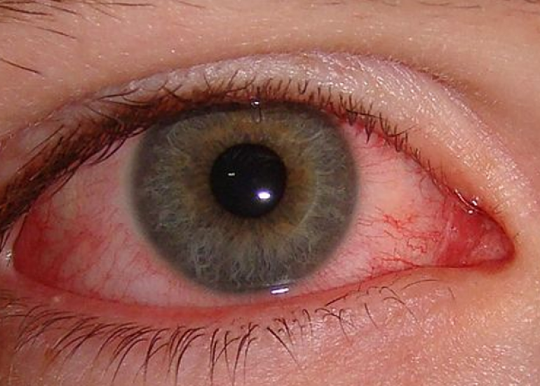 सजोग्रेन सिंड्रोम क्या है? कारण, लक्षण और इलाज | What is Sjogren's Syndrome in Hindi