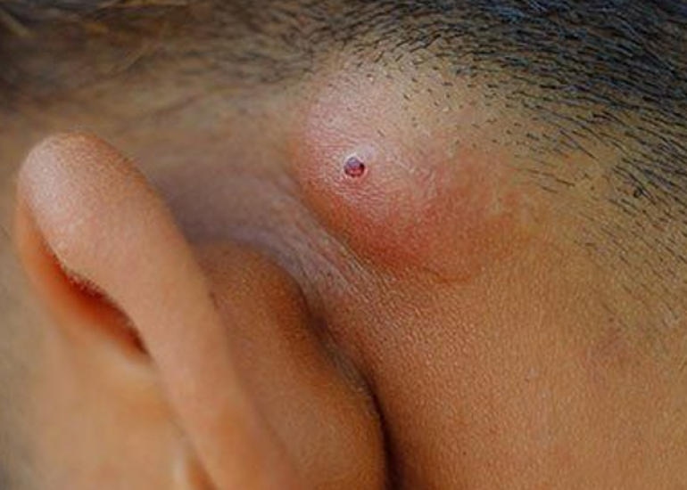 स्टैफ संक्रमण क्या है? कारण, लक्षण और इलाज | What is Staph Infection in Hindi