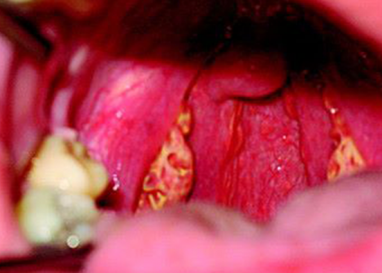 टैंजियर रोग क्या है? कारण, लक्षण और इलाज | What is Tangier Disease in Hindi