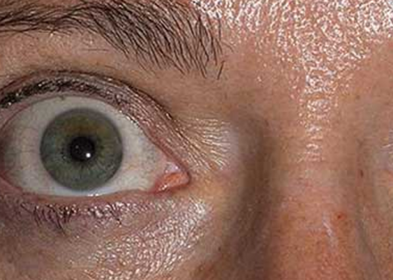 थायराइड नेत्र रोग क्या है? कारण, लक्षण और इलाज | What is Thyroid Eye Disease in Hindi