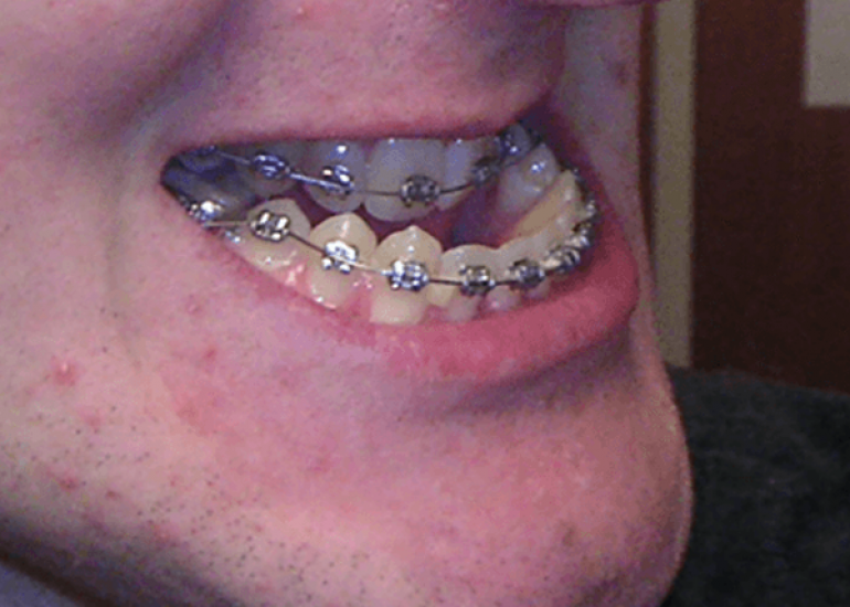 अंडरबाइट क्या है? कारण, लक्षण और इलाज | What is Underbite in Hindi