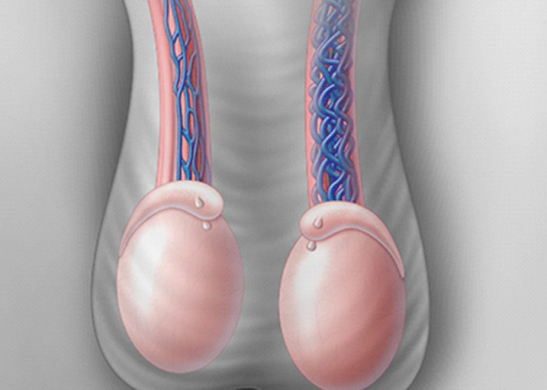 वैरिकोसेले क्या है? कारण, लक्षण और इलाज | What is Varicocele in Hindi