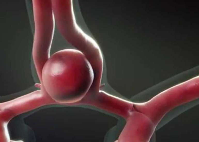 वैसोस्पास्मम क्या है? कारण, लक्षण और इलाज | What is Vasospasm in Hindi