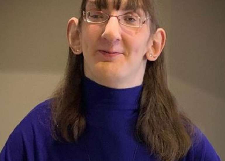 वीवर सिंड्रोम क्या है? कारण, लक्षण और इलाज | What is Weaver Syndrome in Hindi