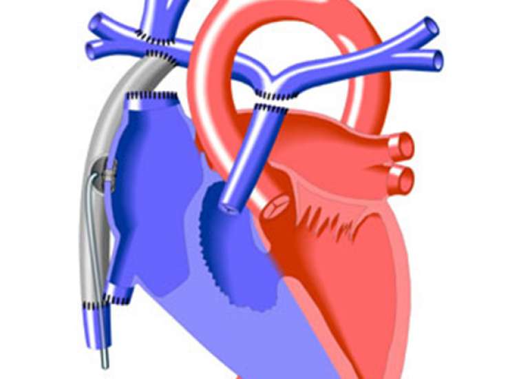 What is the outcome of a fontan surgery?