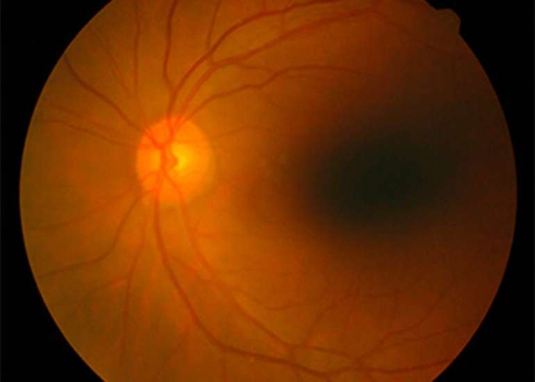 What is Retina?