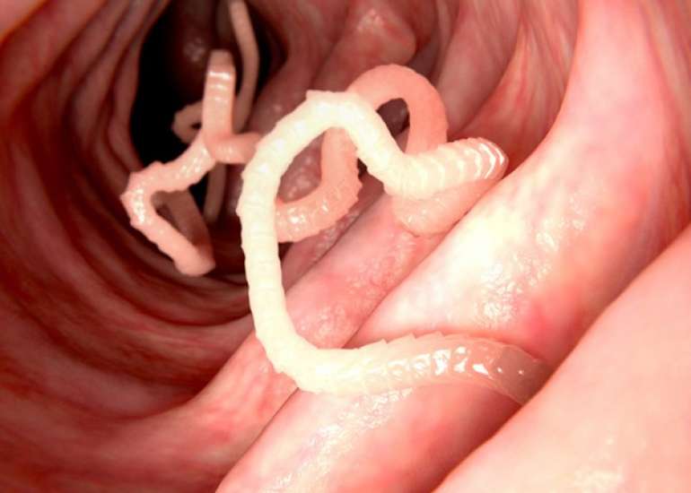 एस्कारियासिस क्या है? लक्षण, कारण, और उपचार  | What is Ascariasis in Hindi