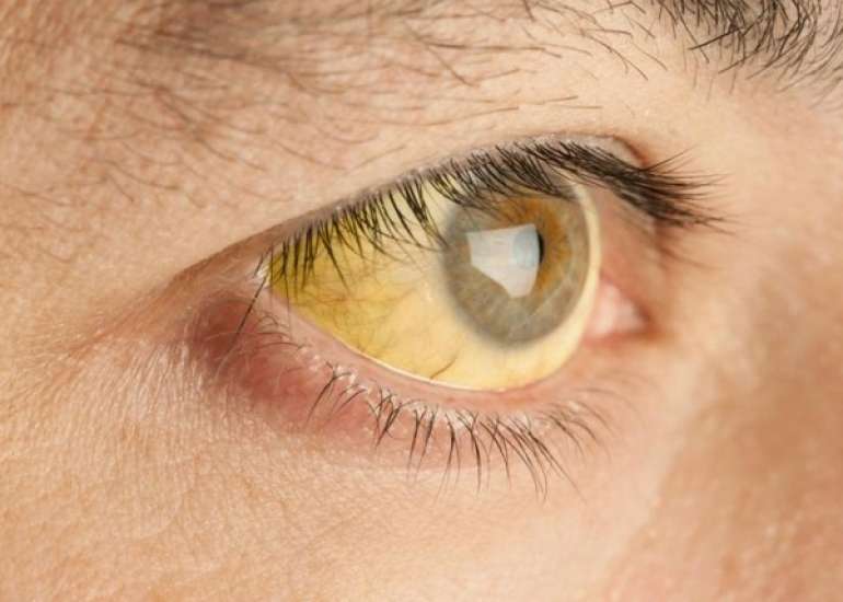 येलो फीवर क्या है | Yellow Fever in Hindi | Medtalks