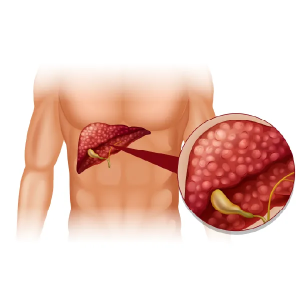Fatty Liver No Longer an Older Age Problem: What Experts Want You to Know