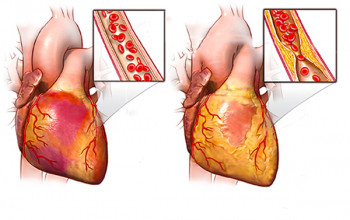 Image Angina - causes, symptoms and treatment?