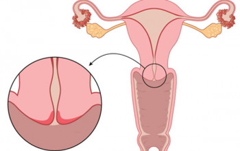 Image Apart from cancer of cervix, which are the gynecological cancer in women?