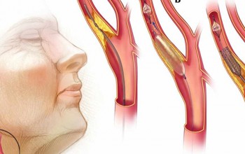Can bypass surgery be done along with Carotid Artery ...