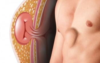 Image Hernia Diet - What Should I Eat/Avoid ?