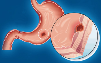 Image How can one evaluate peptic ulcer disease?