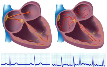 Image How common is atrial fibrillation in underlying rheumatic heart disease?