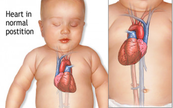 Image How rare is Dextrocardia?