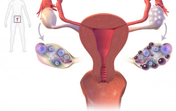 Image How should we proceed once we suspect PCOS?