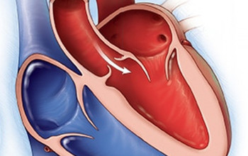 Image How we manage a VSD with some degree of aortic regurgitation?