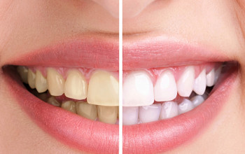 Image How to remove Brown Stain from Teeth