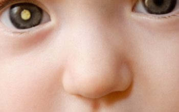 Image How is cataract managed in children?