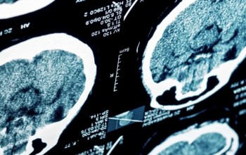 Image Sleep Behaviors and Subcortical Brain Structures in Children with Overweight/Obesity