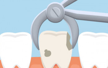 Image Steps to be taken before Tooth Removal Procedure