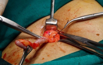 Image Surgical management of acute appendicitis?