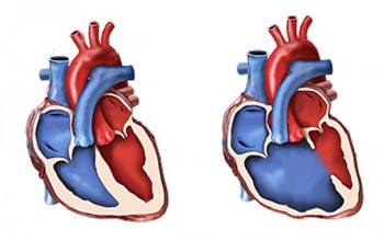 Image What is congenital heart disease?