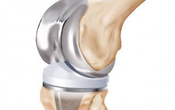 Image What are high flexibility implants?