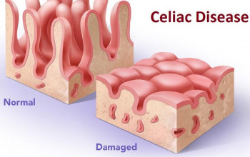 Image What causes Gluten Intolerance (celiac disease)?