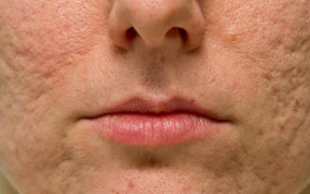 Image What is Acne?