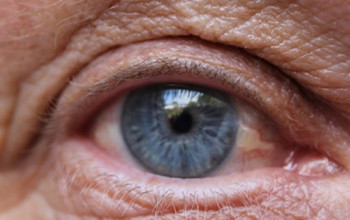 Image What is Age related macular Degeneration?