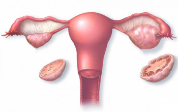 Image What is PCOS?