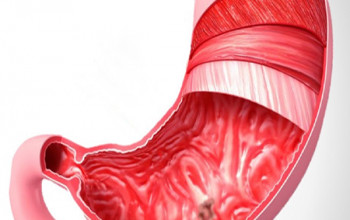 Image What is peptic ulcer?