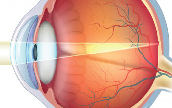 Image What is refractive error and what are the causes of refractive error?