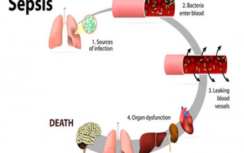 Image What is the definition of sepsis?