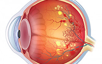 Image What is the impact of high blood pressure on retina?
