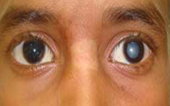 Image What about Cataract in children?