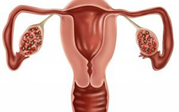 Image What are the cardial feature for diagnoss of PCOS?