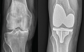 Image What are the results of total knee replacement?