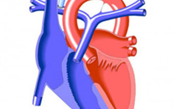 Image What is BT shunt, left BT shunt, right BT shunt and modified BT shunt?