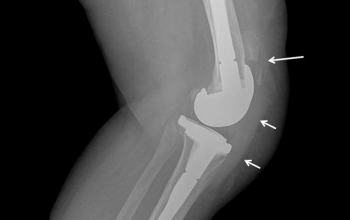 Image What is Patellar knee replacement?