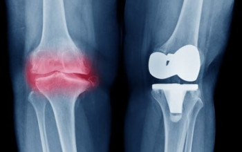 Image What is a total knee replacement?