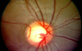 Image What is steroid induced glaucoma?