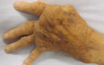 Image When should we start biologics Rheumatoid Arthritis?