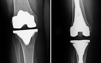 Image Why do knee replacements fail?