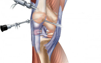 Image What is the role of arthroscopy in osteoarthritis knee?