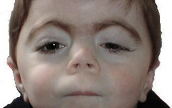 All You Need To Know About Cornelia de Lange Syndrome
