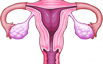 Image What are the basic investigations of PCOS?