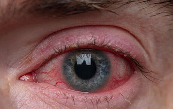 ब्लेफेराइटिस क्या है? कारण, लक्षण और इलाज | Blepharitis in Hindi